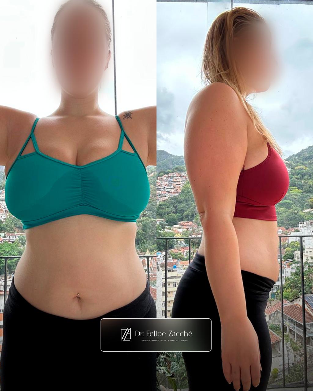 Antes / Depois